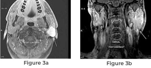 Parotid Tumor Surgery: Understanding the Procedure and Recovery